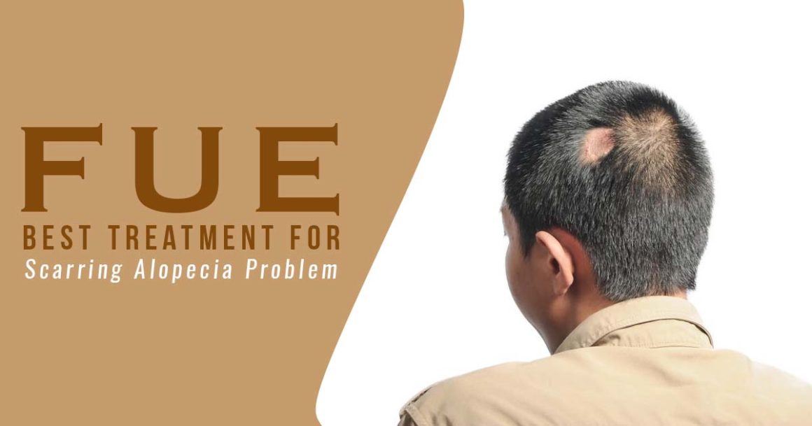 FUE : Best Treatment for Scarring Alopecia Problem